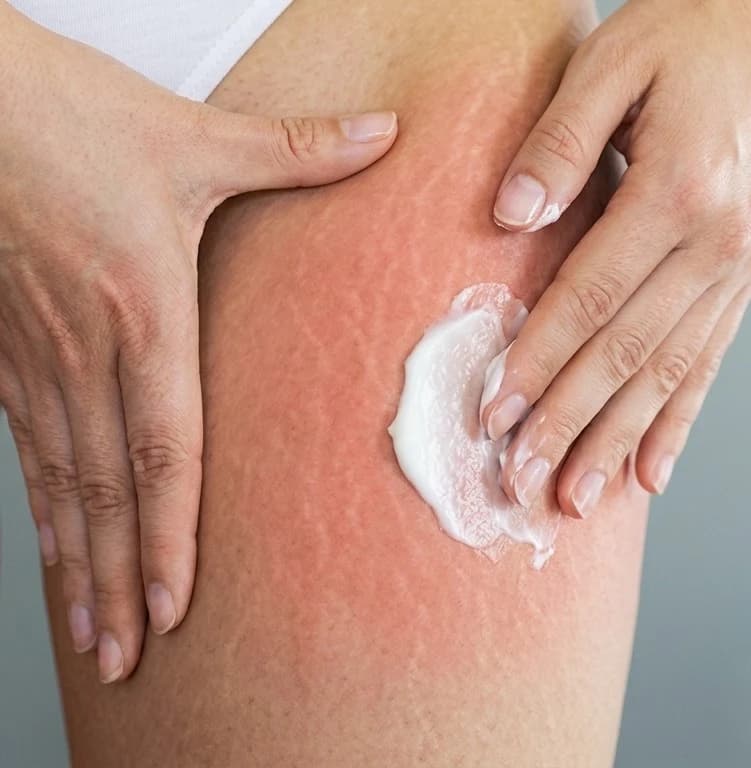 Aplicação de creme corporal durante uma massagem na coxa