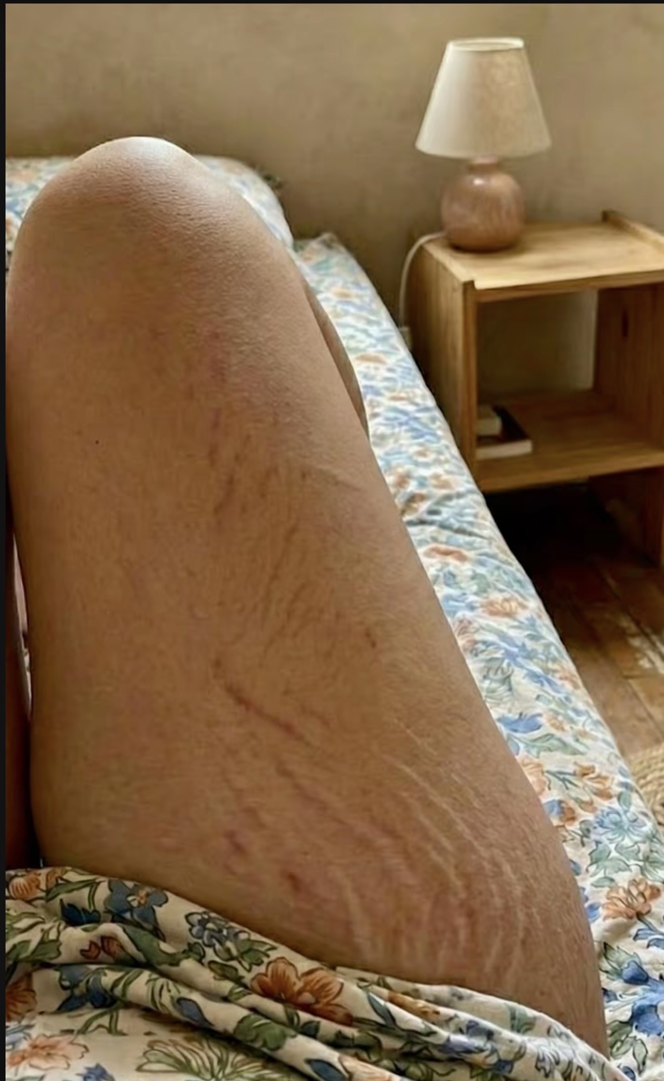 Antes do uso de SunBun