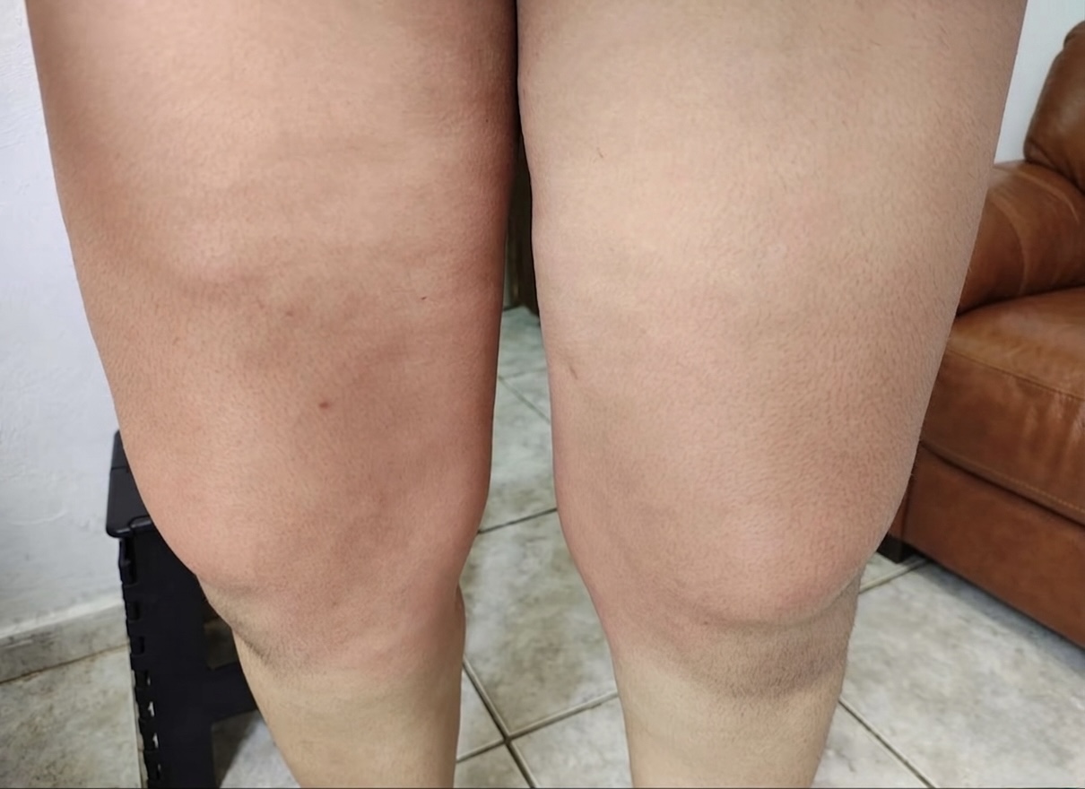 Antes e depois do uso de SunBun